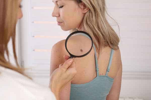 What Are Traditional Skin Lesion Removal Methods Rugby?