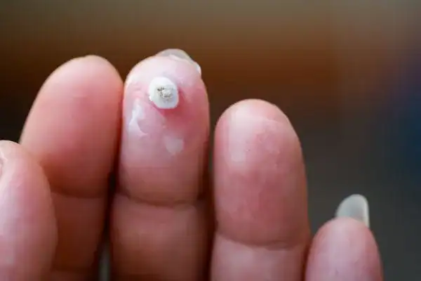 Image of white wart before cryopen treatment Rugby