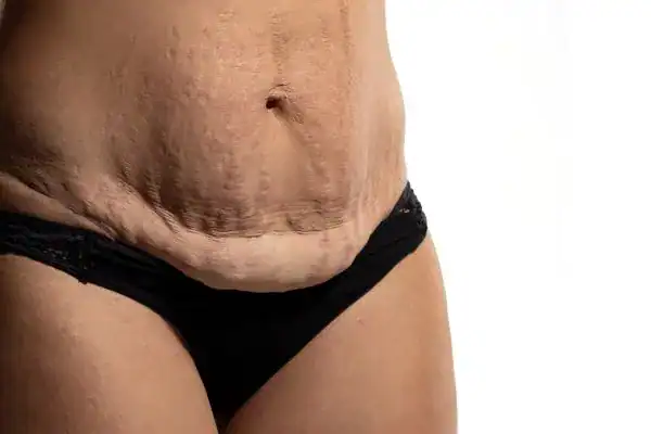 loose skin after weight loss injections Rugby