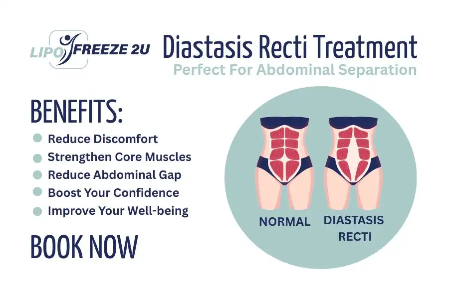 Benefits of body toning treatment Rugby for Diastasis recti