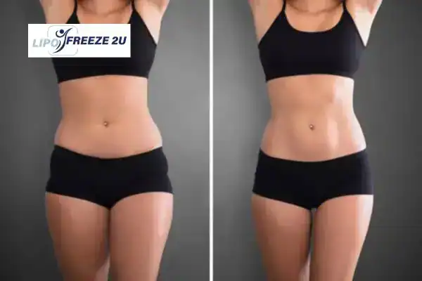 How Can LIPO FREEZE 2U Support Your Post-Pregnancy Body Recovery Rugby?