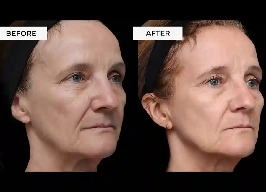 How Many RF Microneedling Sessions Will You Need to See a Difference Rugby?