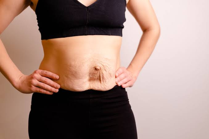 Is Surgery Really the Only Way to Repair Diastasis Recti Rugby?