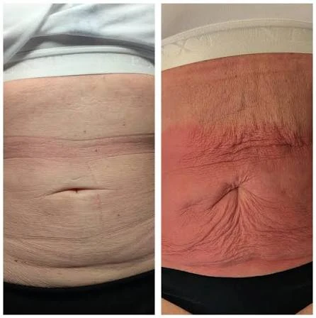 How Does RF Microneedling Improve Crepey, Thin and Uneven Skin Texture Rugby?