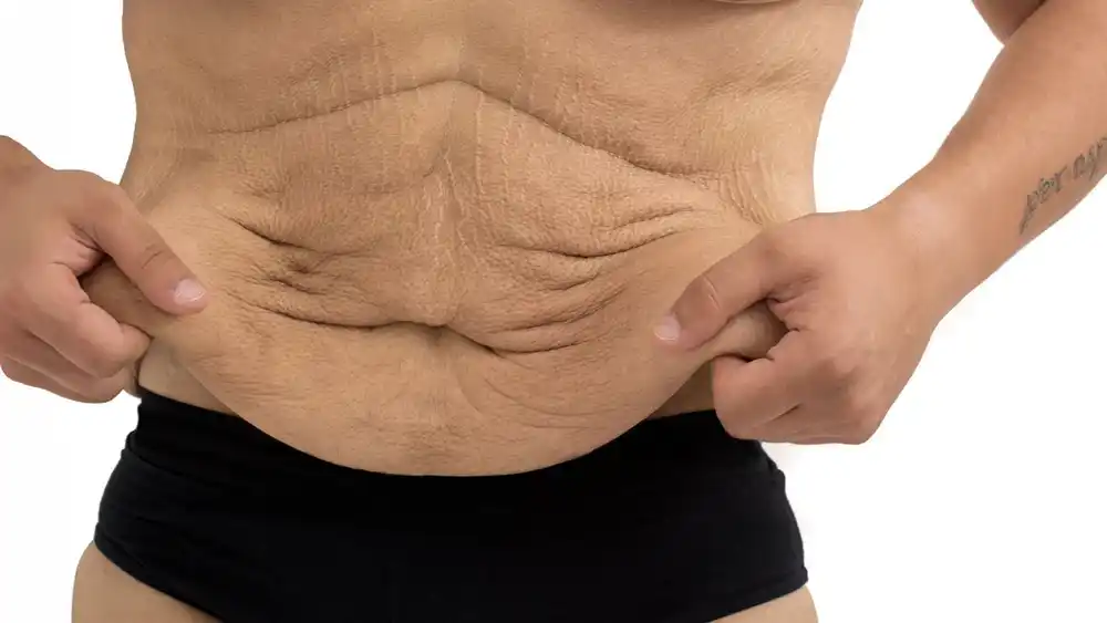 RF Microneedling for Loose Skin: How Can It Help Tighten and Reshape the Skin Rugby?